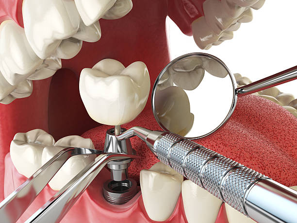 Best Emergency Dental Care for Broken or Chipped Teeth in Elk River, MN